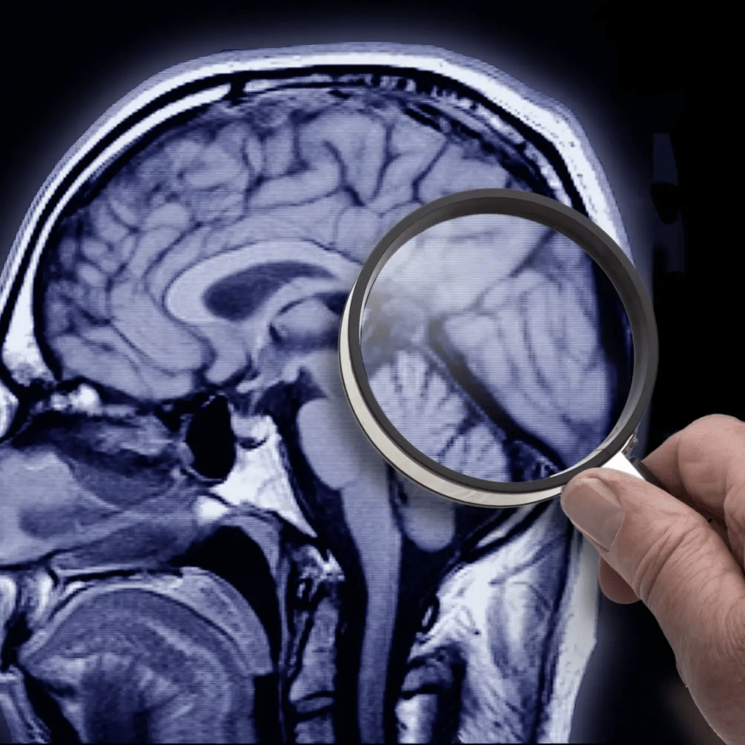 “Era das curas”? Pesquisadores conseguem remover placas do Alzheimer e mostram melhora em estudos iniciais