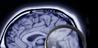 “Era das curas”? Pesquisadores conseguem remover placas do Alzheimer e mostram melhora em estudos iniciais