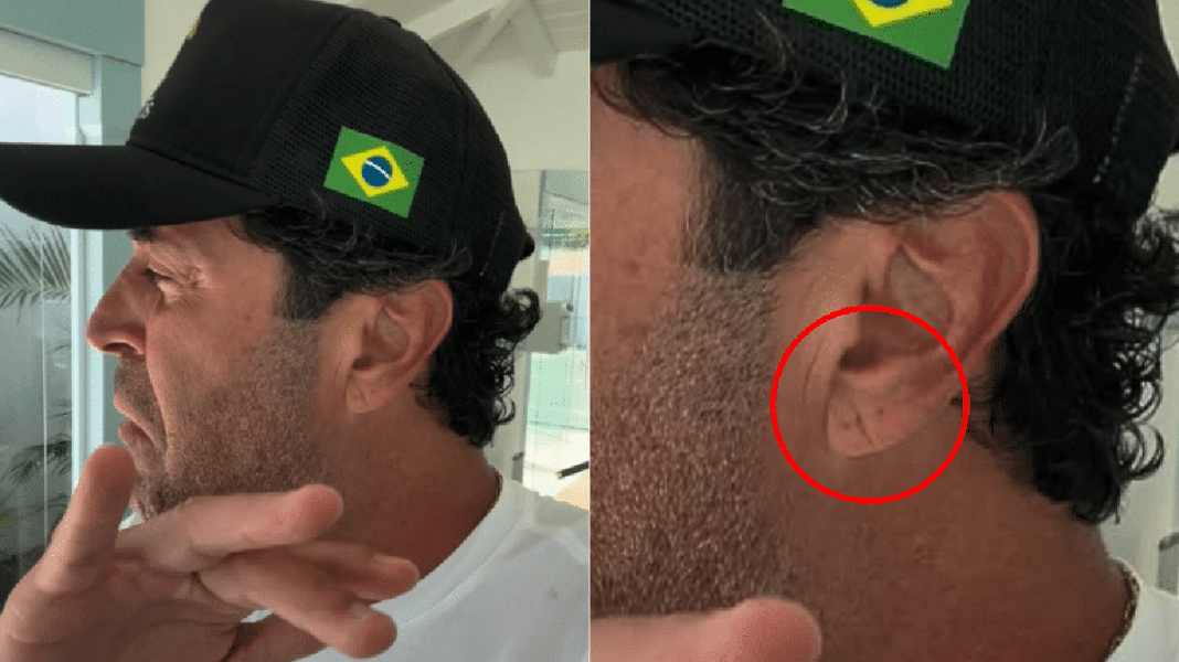 Dobra na orelha pode indicar risco de infarto? Morte de Madeirite gerou debate nas redes.