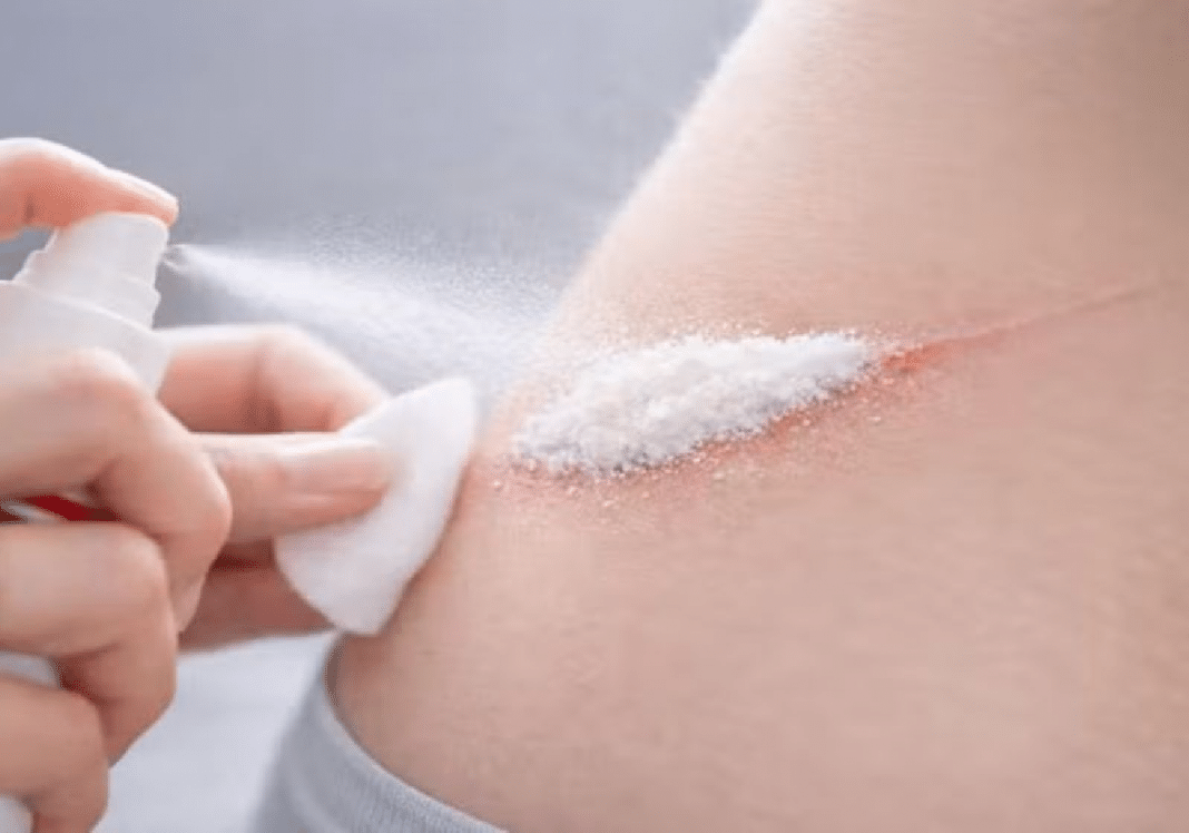 Cientistas criam spray que estanca hemorragias em menos de 1 segundo