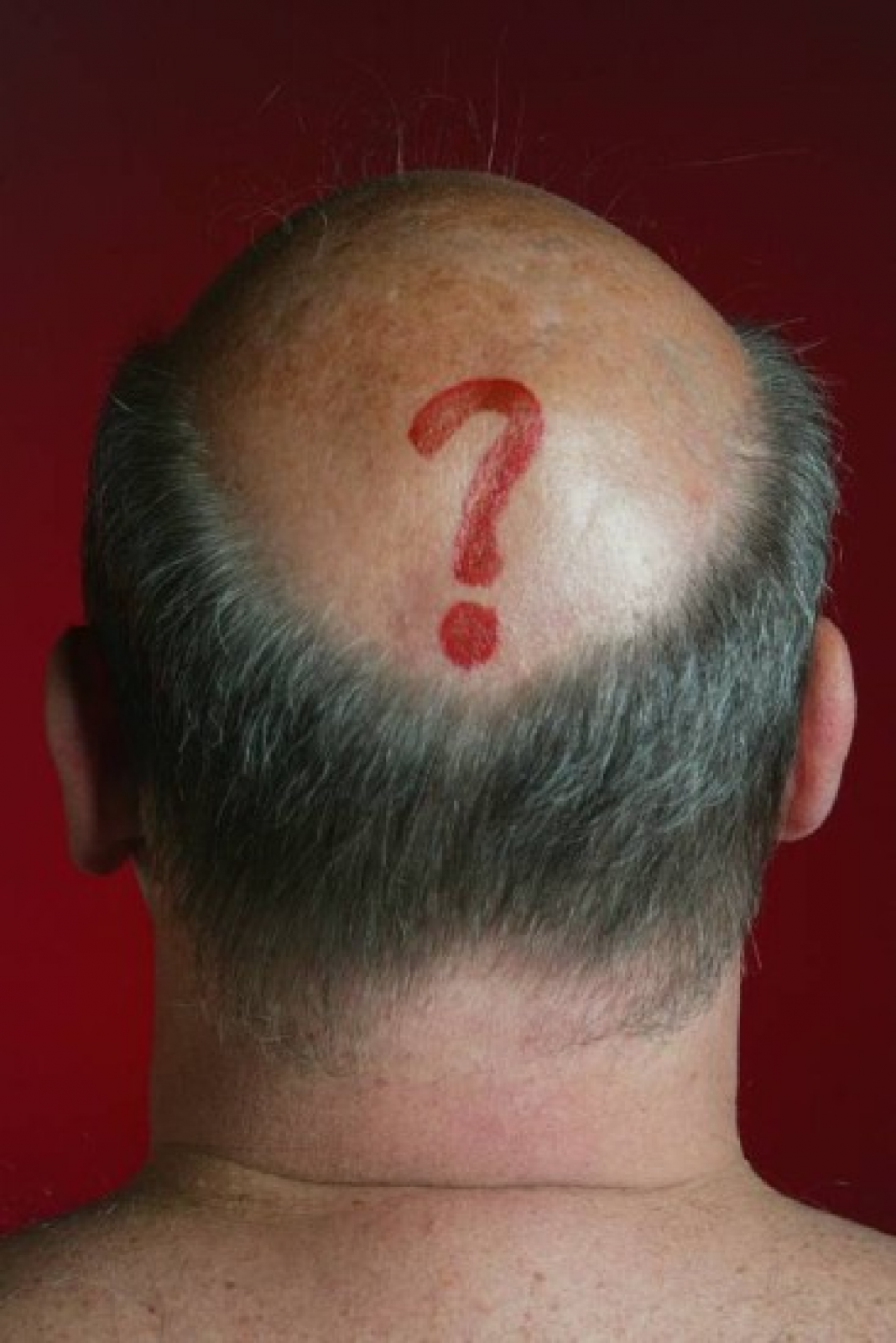 “Fim da calvície? Cientistas de Taiwan descobrem método que faz cabelo voltar a crescer em poucos dias