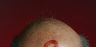 “Fim da calvície? Cientistas de Taiwan descobrem método que faz cabelo voltar a crescer em poucos dias