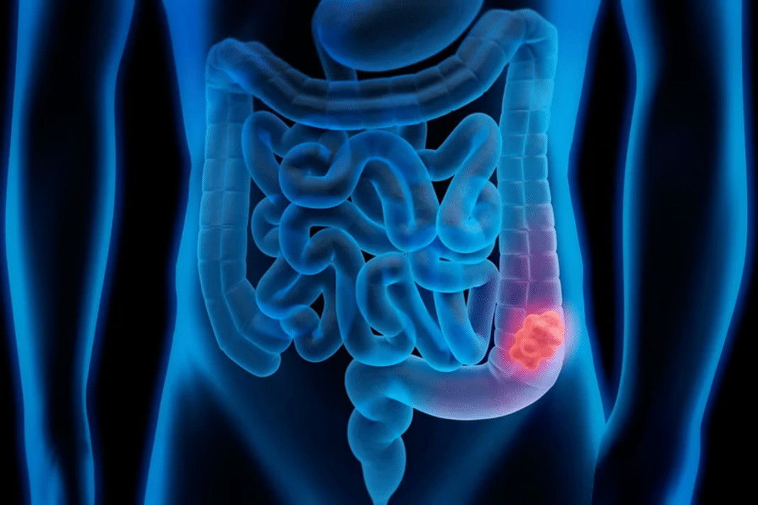 A dieta silenciosa que especialistas dizem ser “pior que fumar” — e pode estar destruindo seu intestino