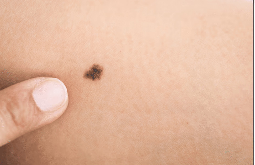 O que significa ter uma marca de nascença no corpo? a explicação chama atenção