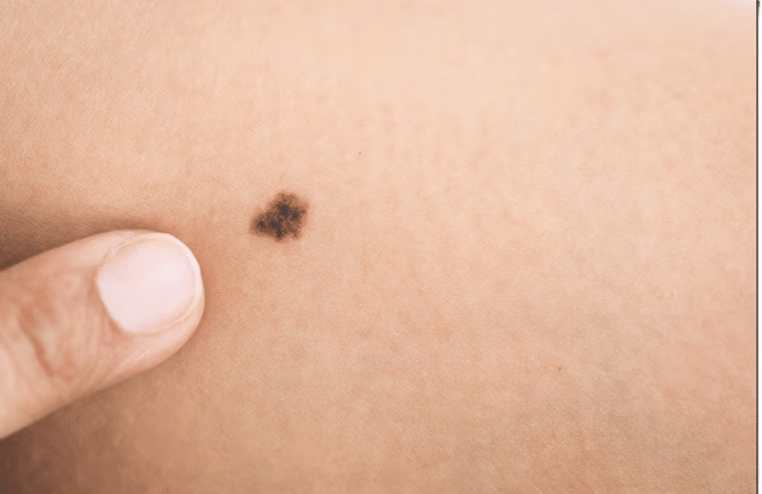 O que significa ter uma marca de nascença no corpo?