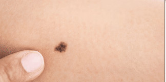 O que significa ter uma marca de nascença no corpo? a explicação chama atenção