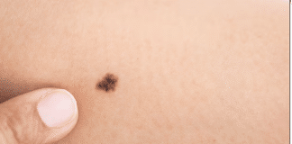 O que significa ter uma marca de nascença no corpo?